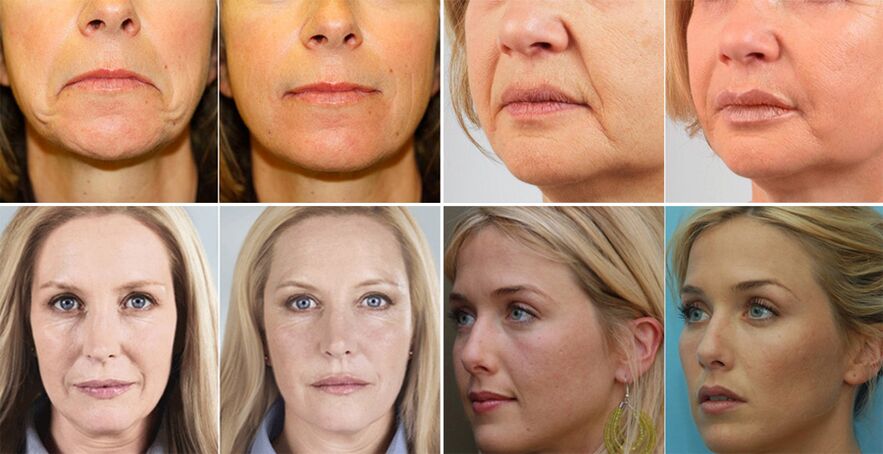 صور نساء قبل وبعد تجديد بشرة الوجه